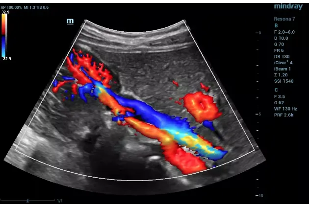 color doppler ultrasound