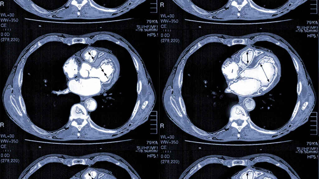 heart ct scans 1296x728 header 1024x575