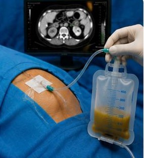 drenazhi i abscesit renal dhe perirenal
