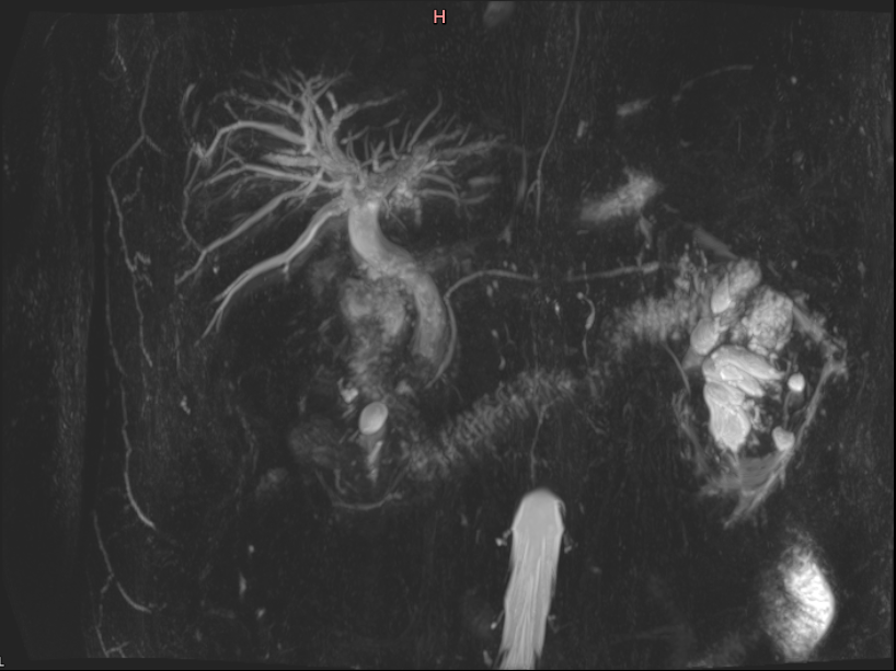 mrcp