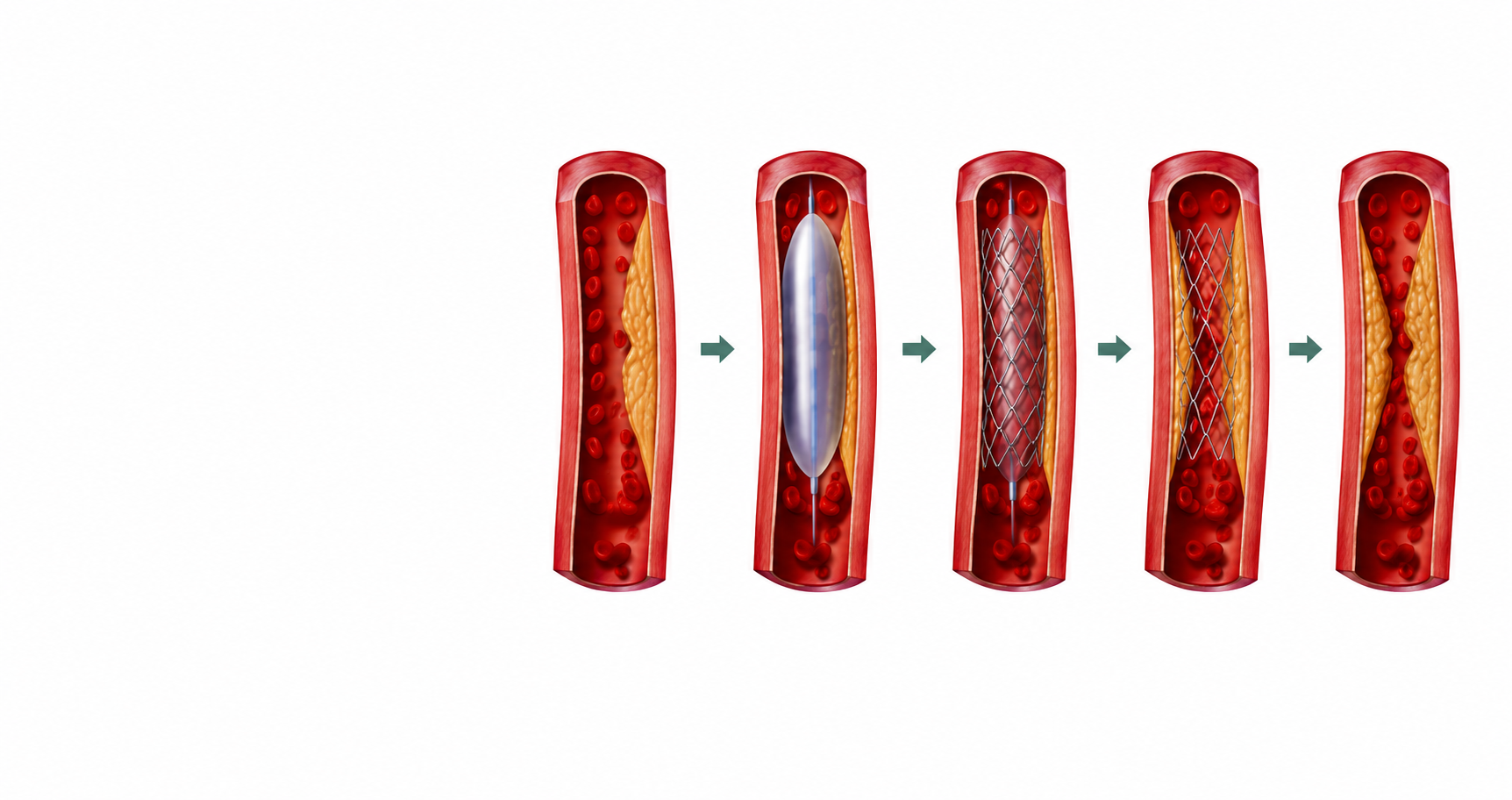 ristenoza pas angioplastikës ose stentimit