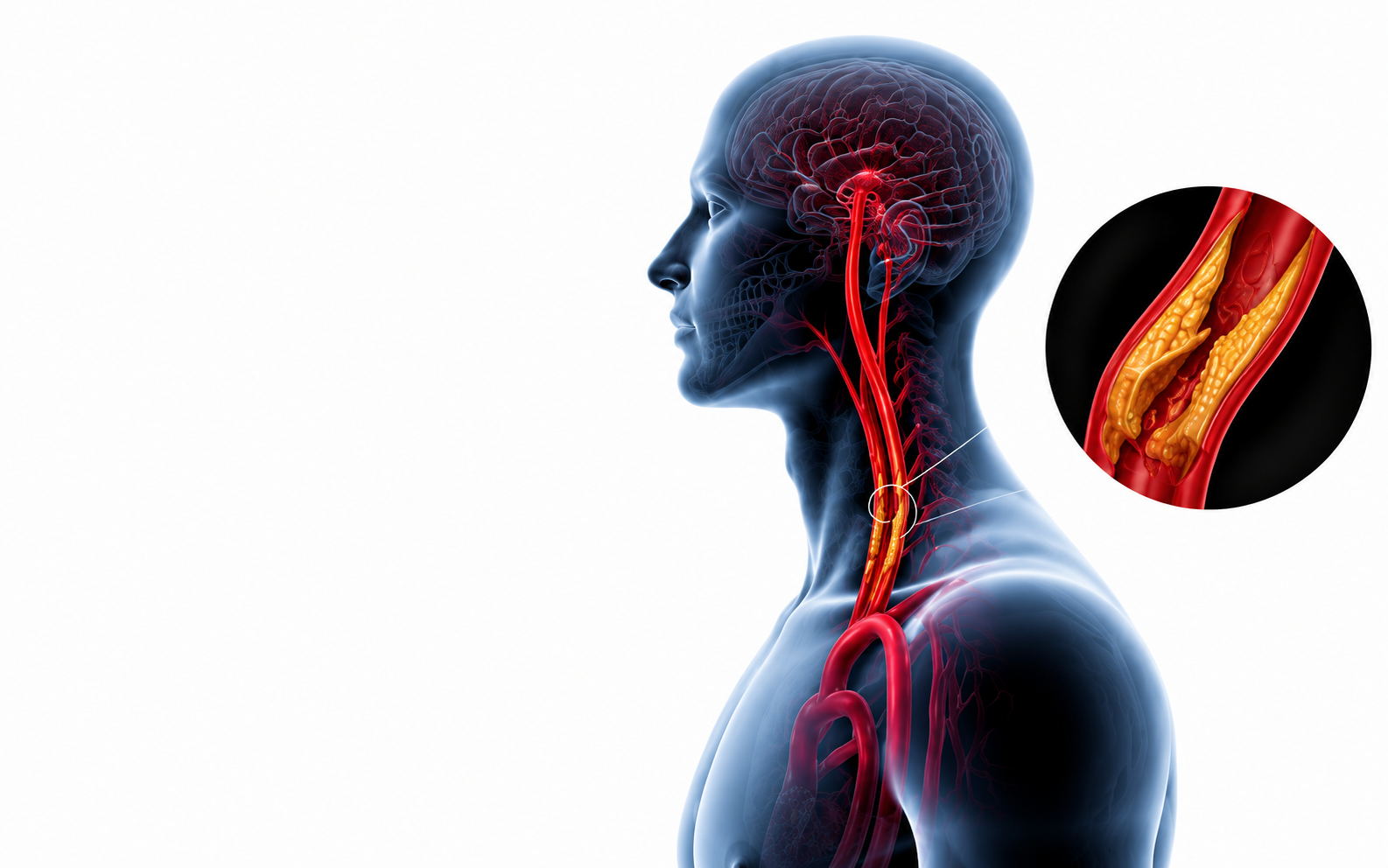 sëmundja e arterieve karotide