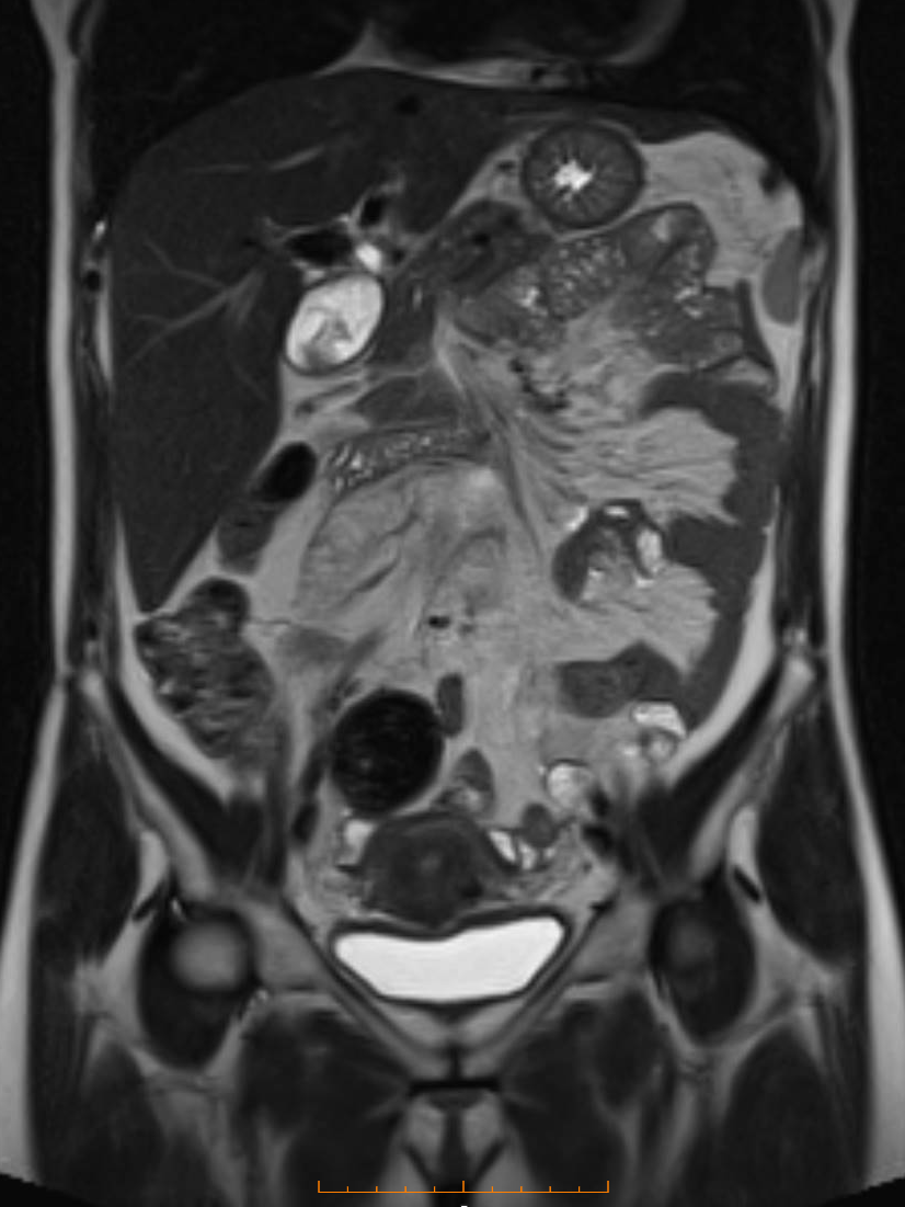 abd pevis mri