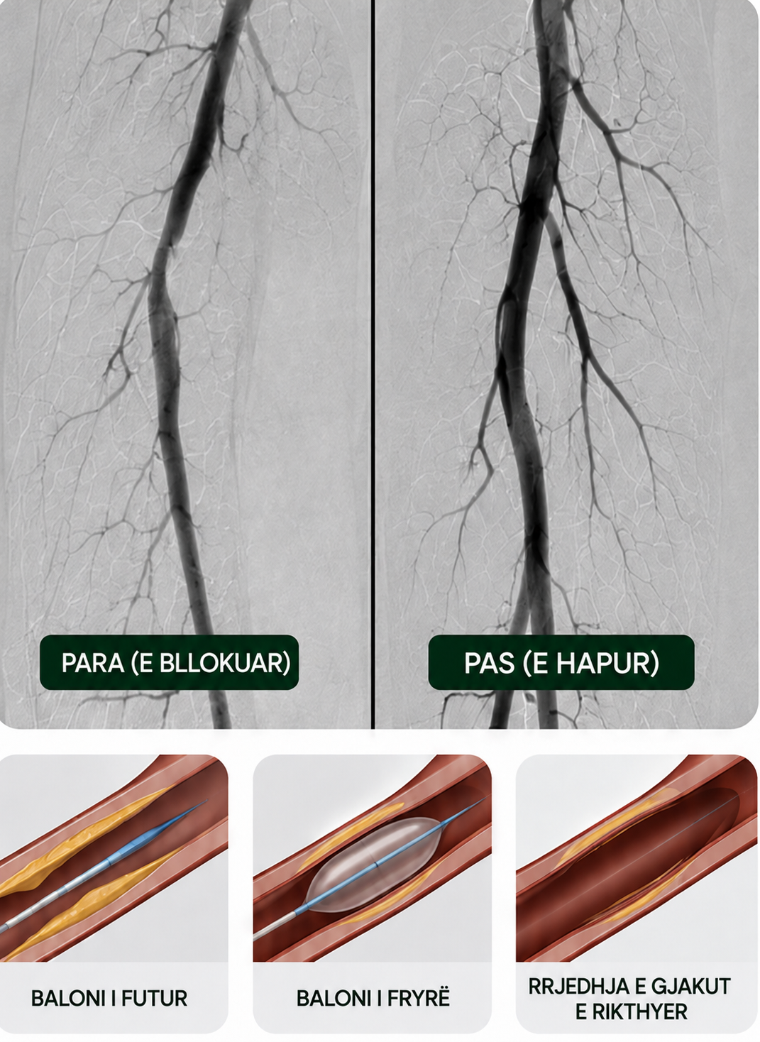 angioplastika periferike pta