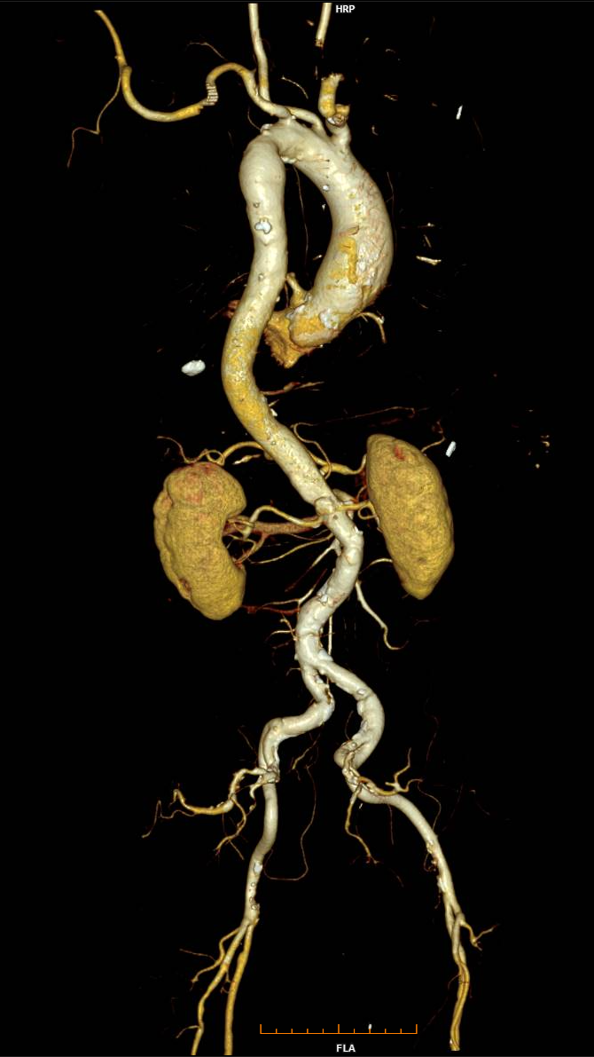 aorta