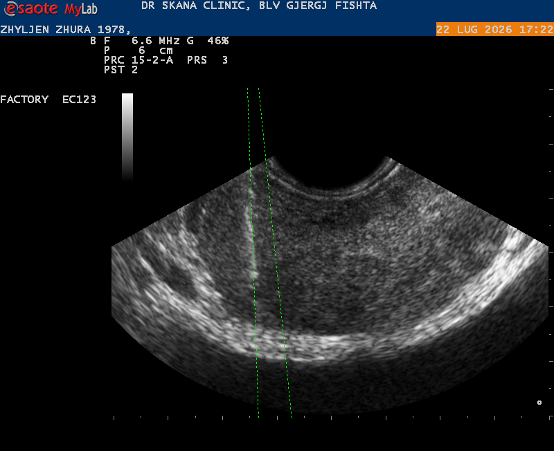 biopsi prostate
