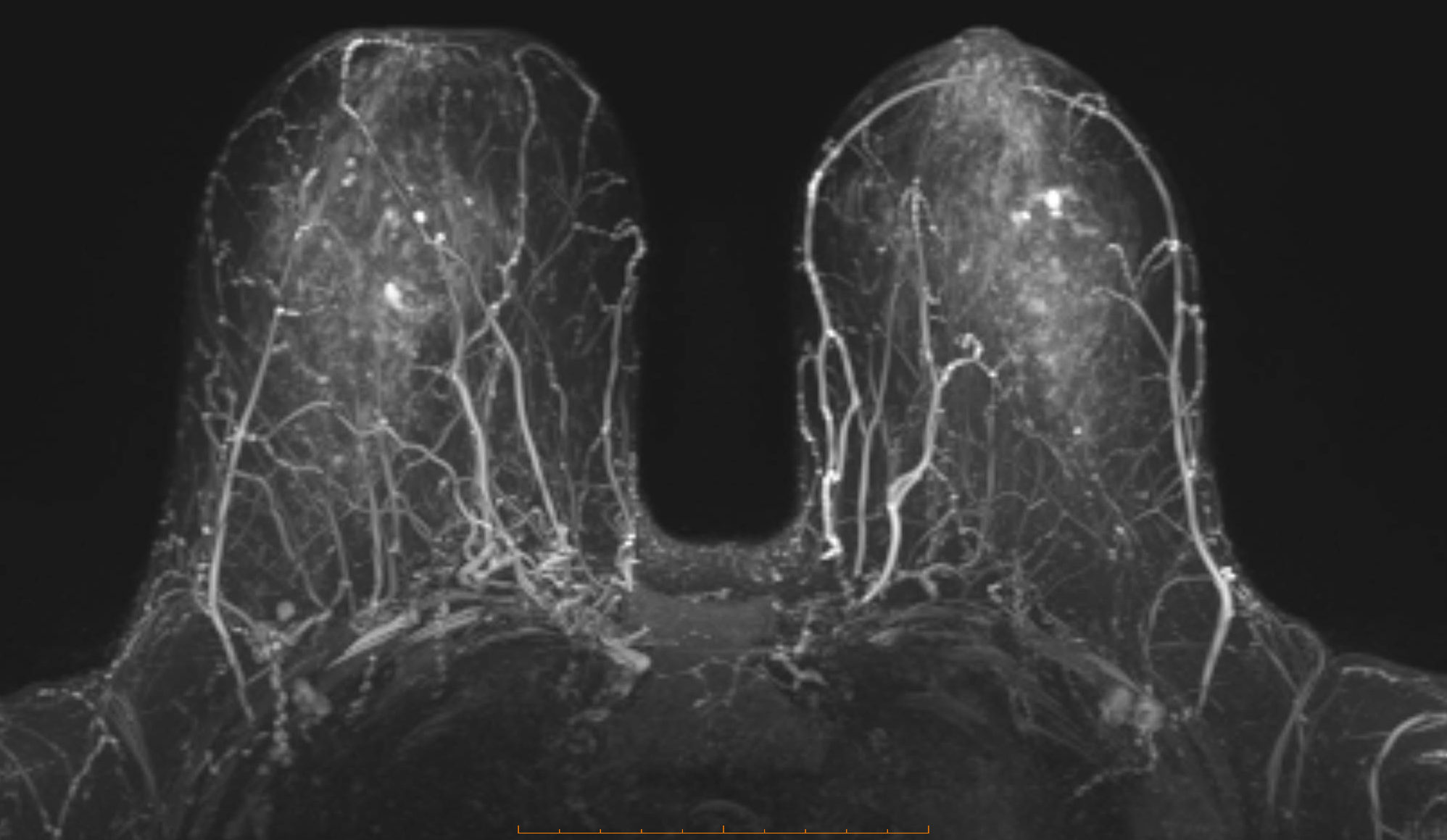 breast mri