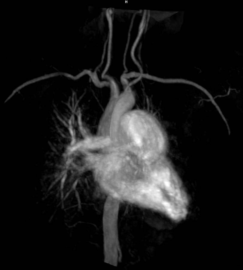 cardiac recon 2