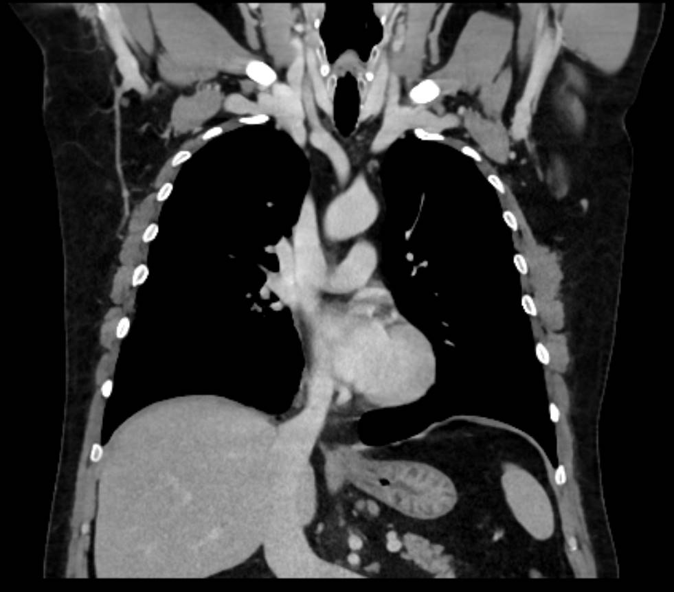 chest ct