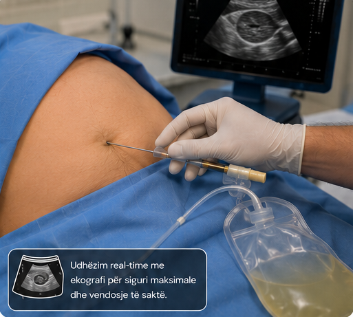 drenazh i likidit peritoneal