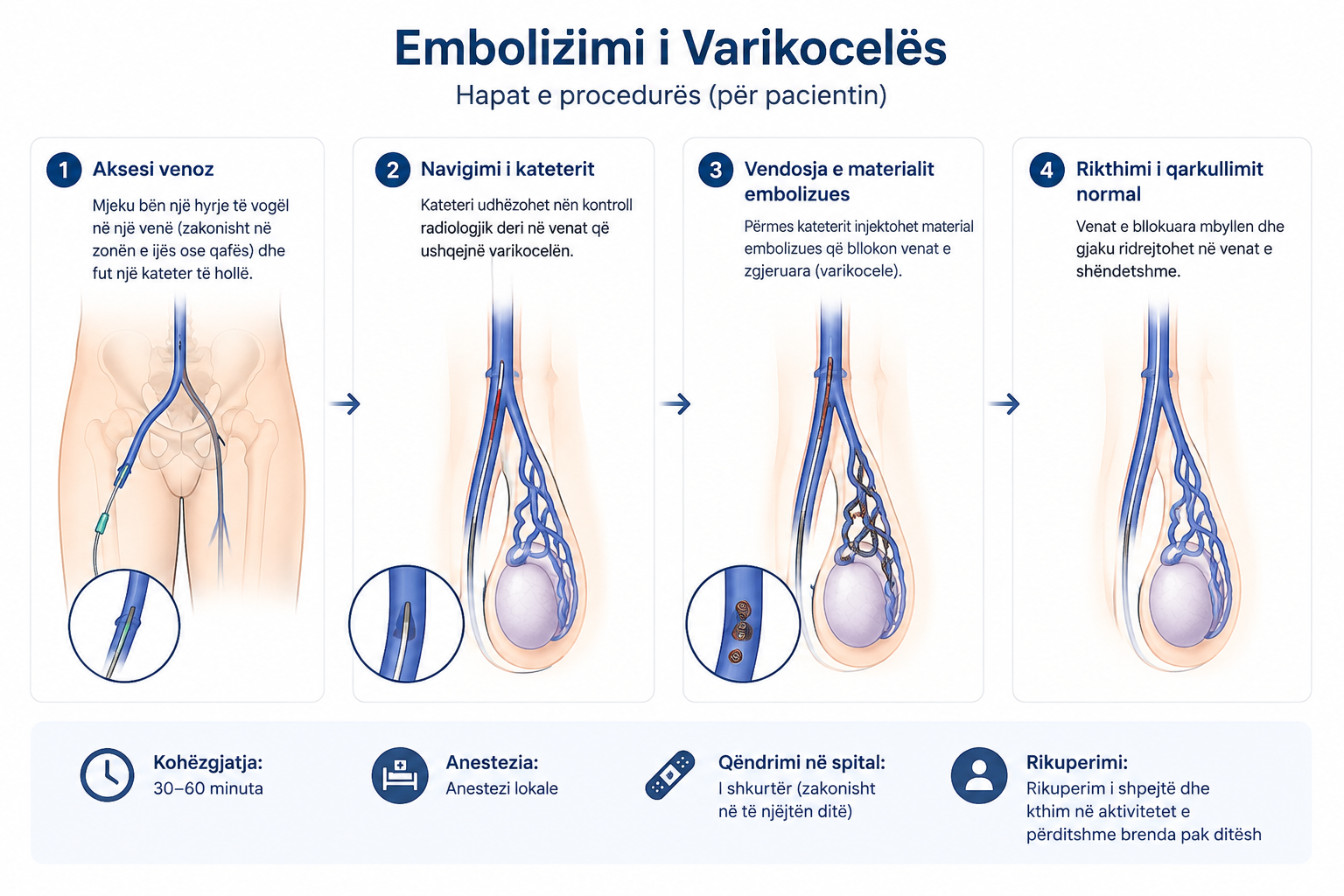 embolizimi varikoceles (2)