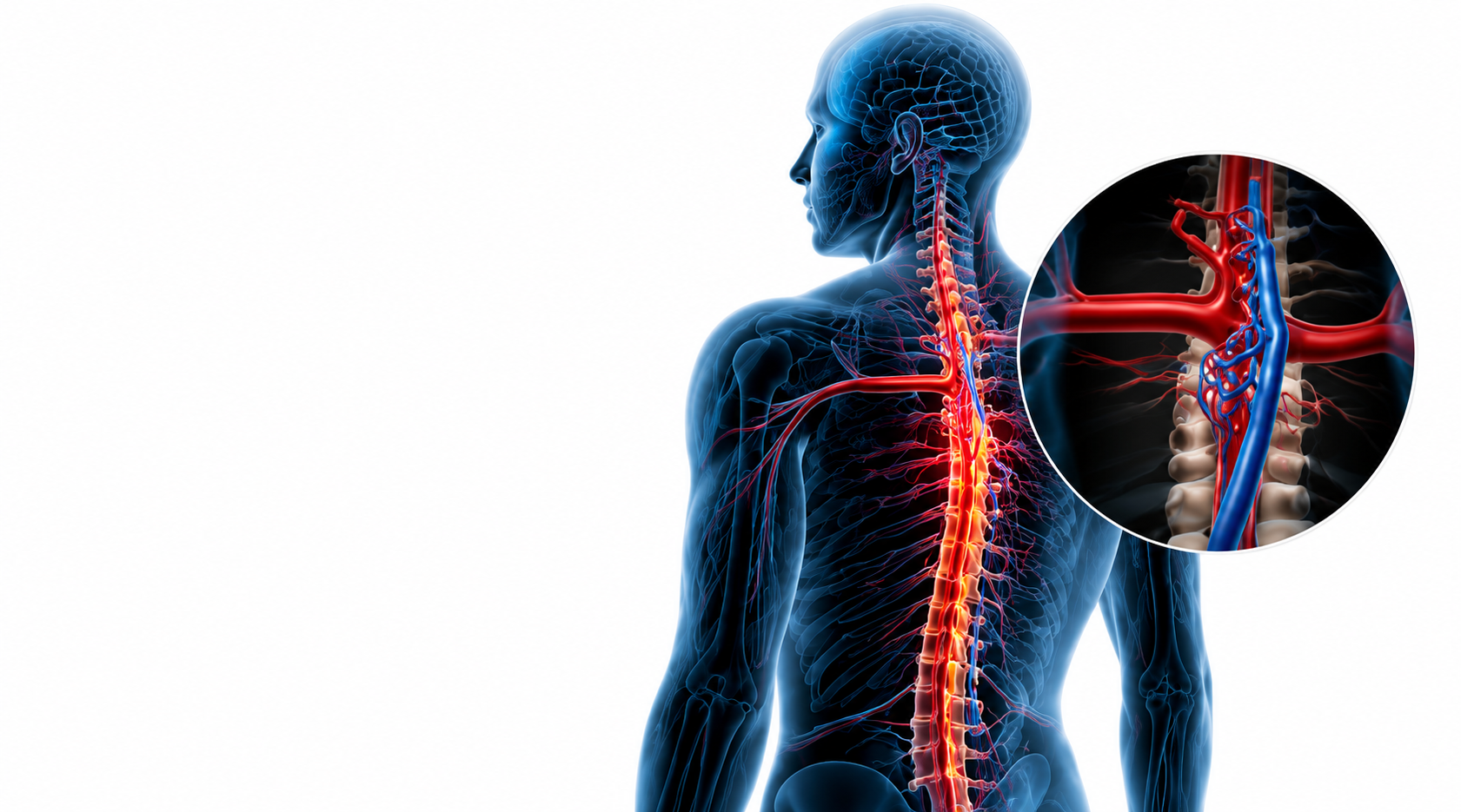 fistulës arteriovenoze spinale