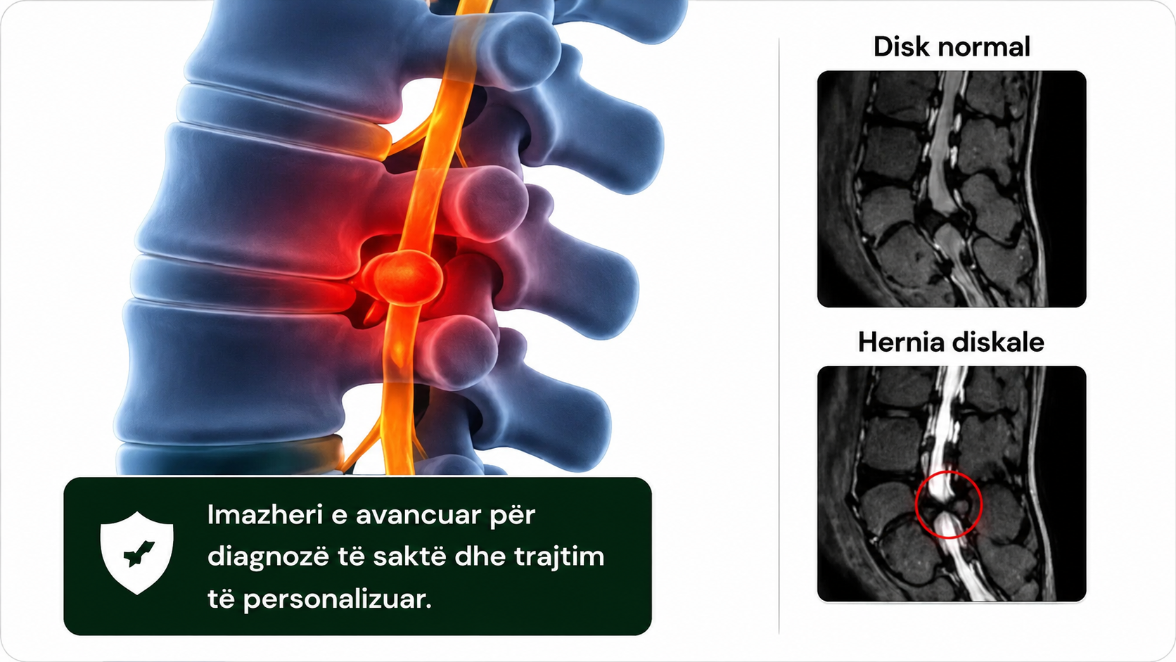 hernia diskale