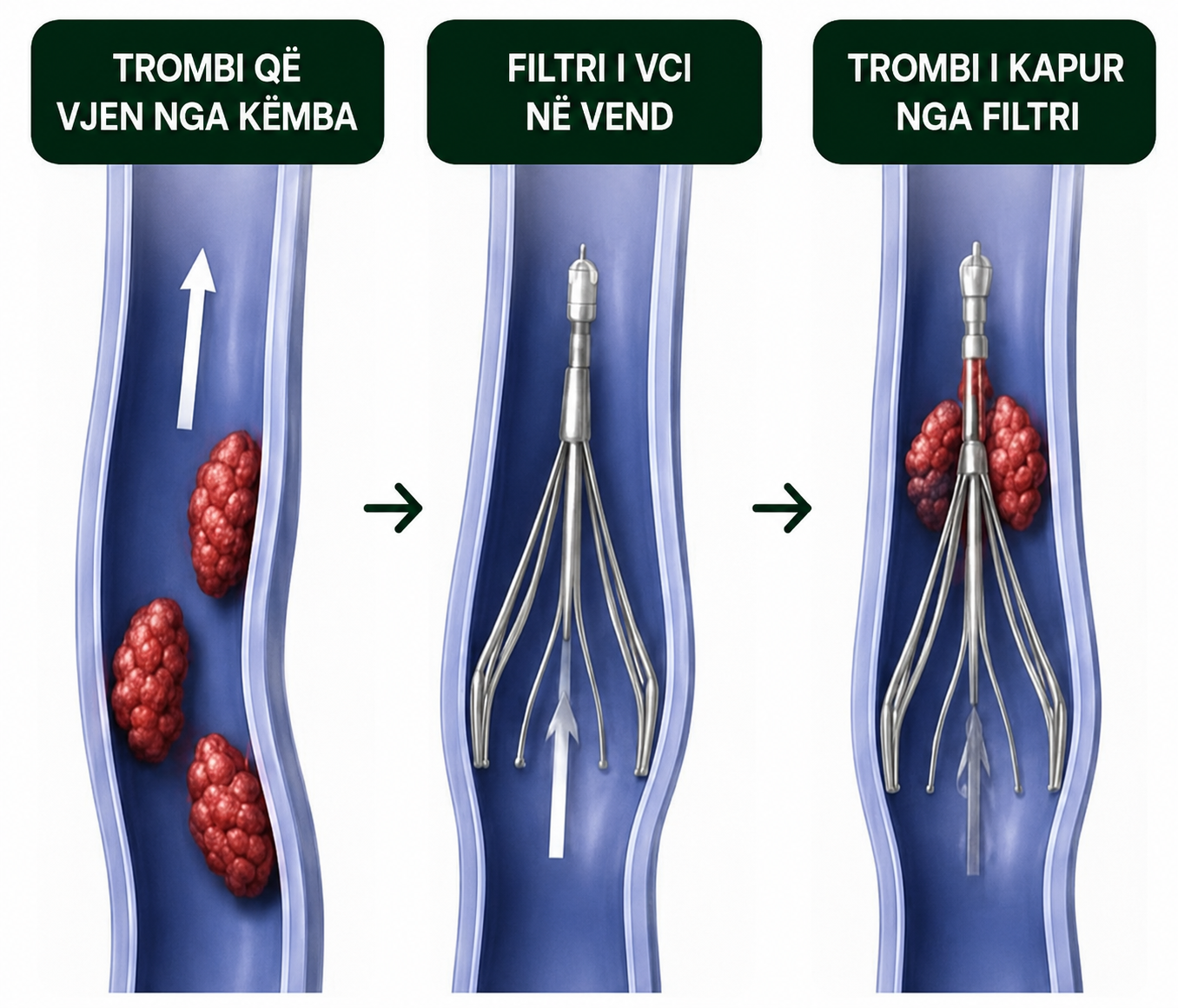 ivc filter