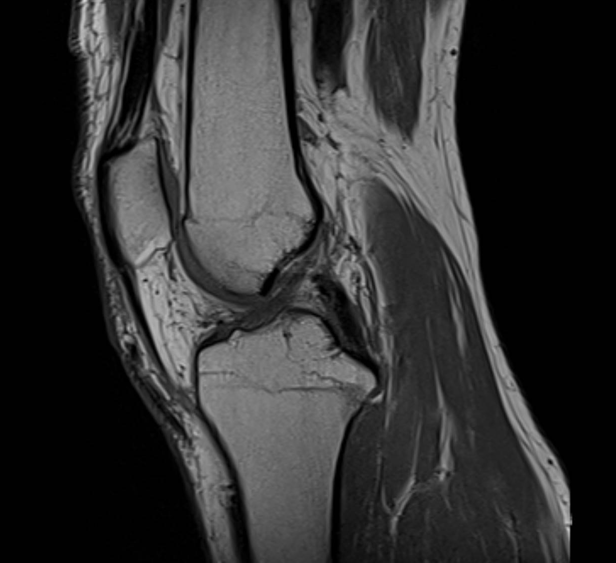knee mri