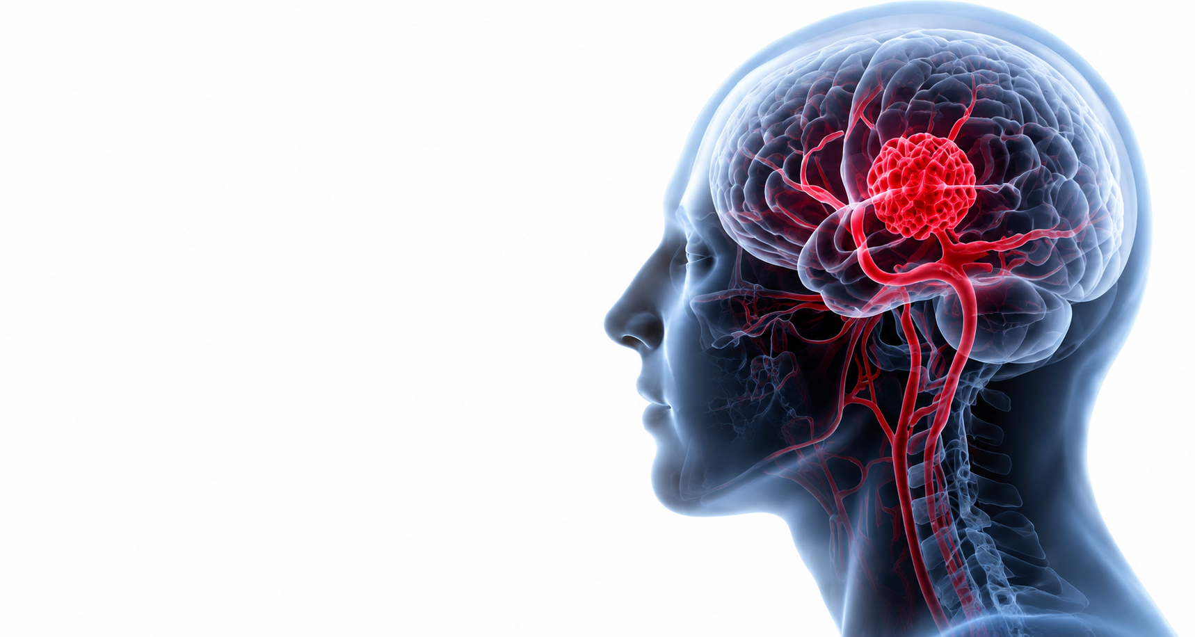 malformaconet cerebrale