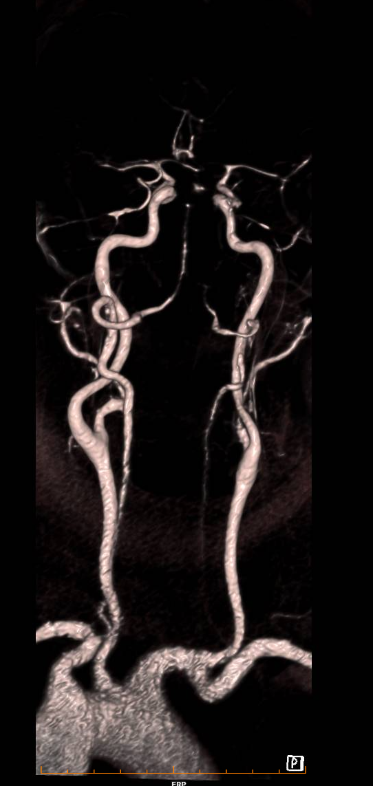 mra carotide 2