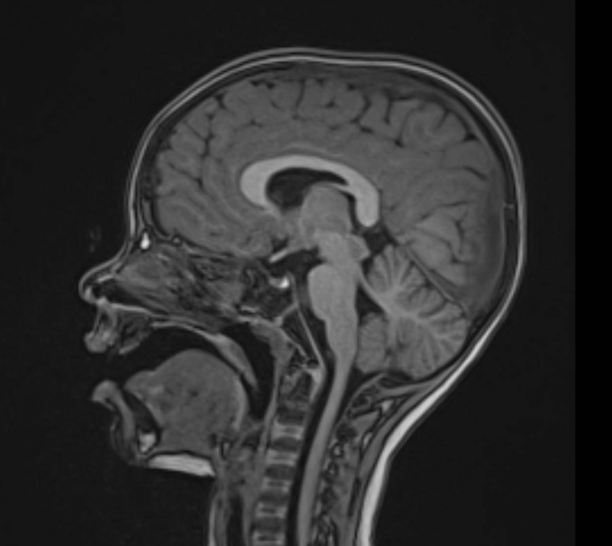 pedatric head mri