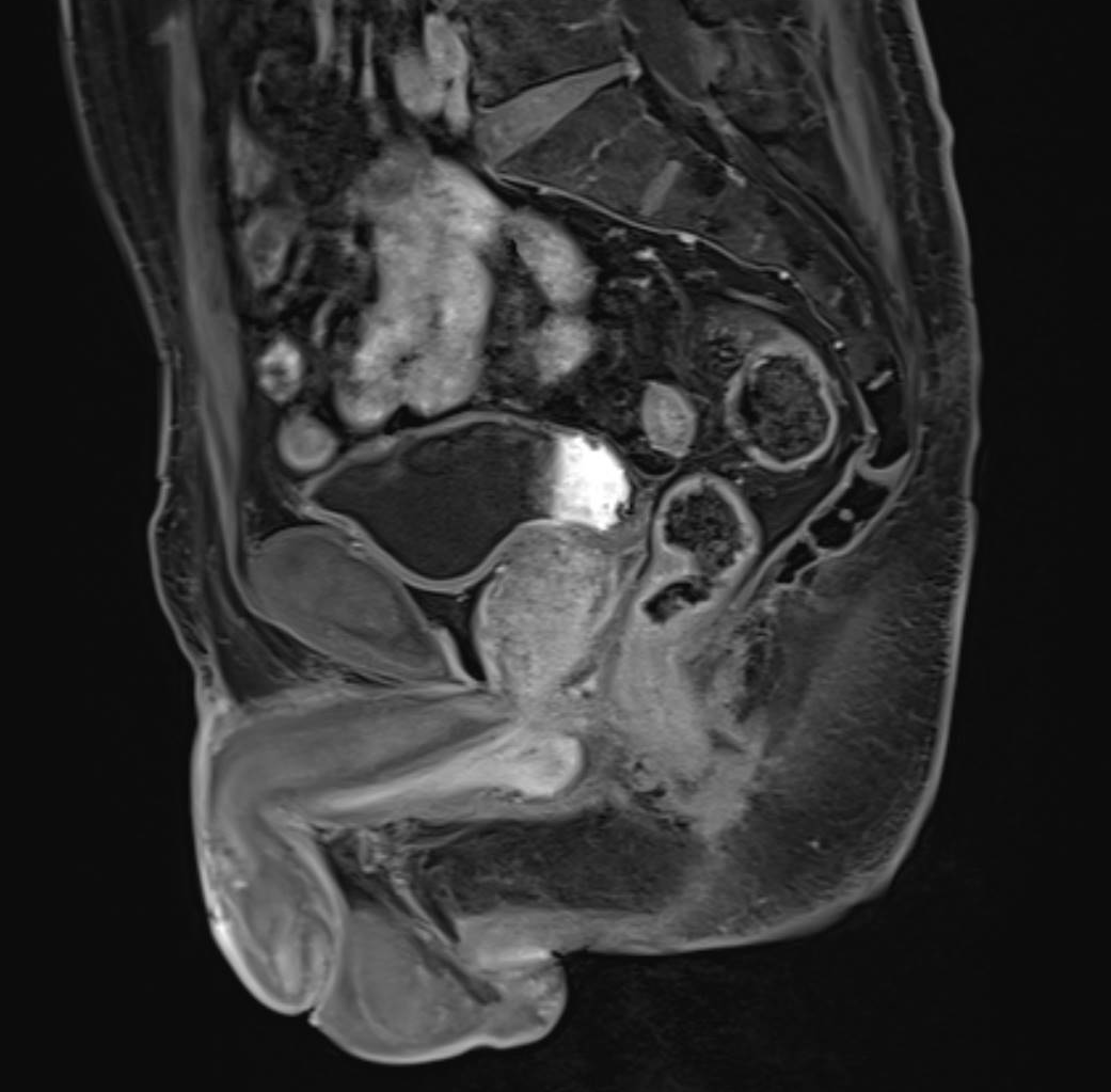 pelvi prostate mri