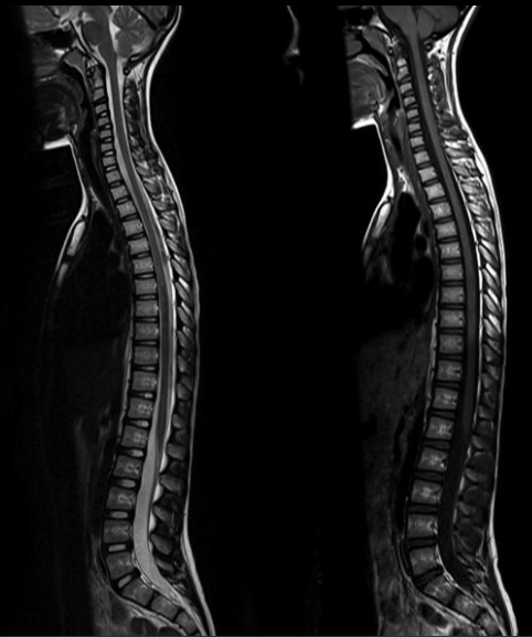 spine