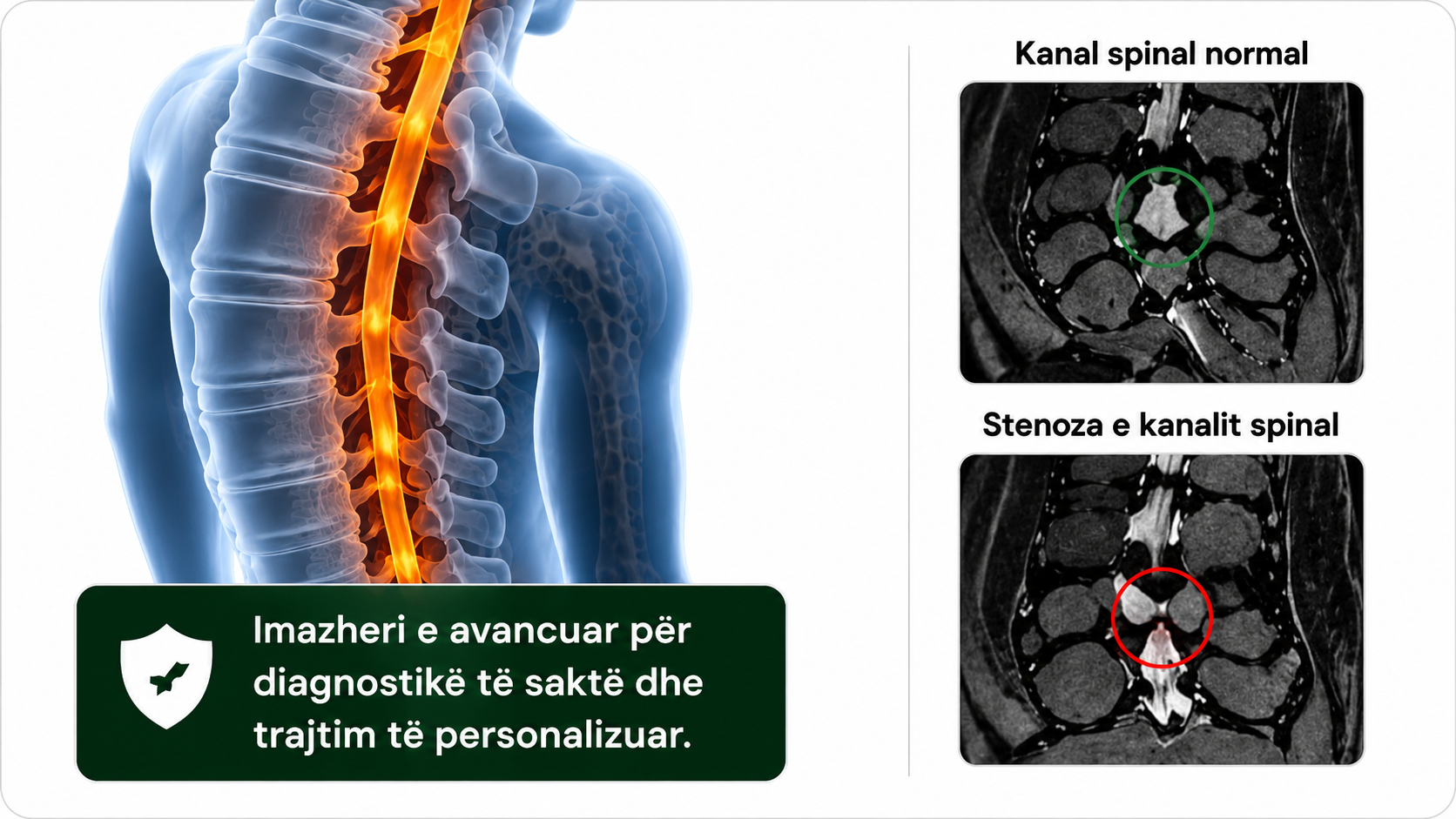 stenoza e kanalit spinal