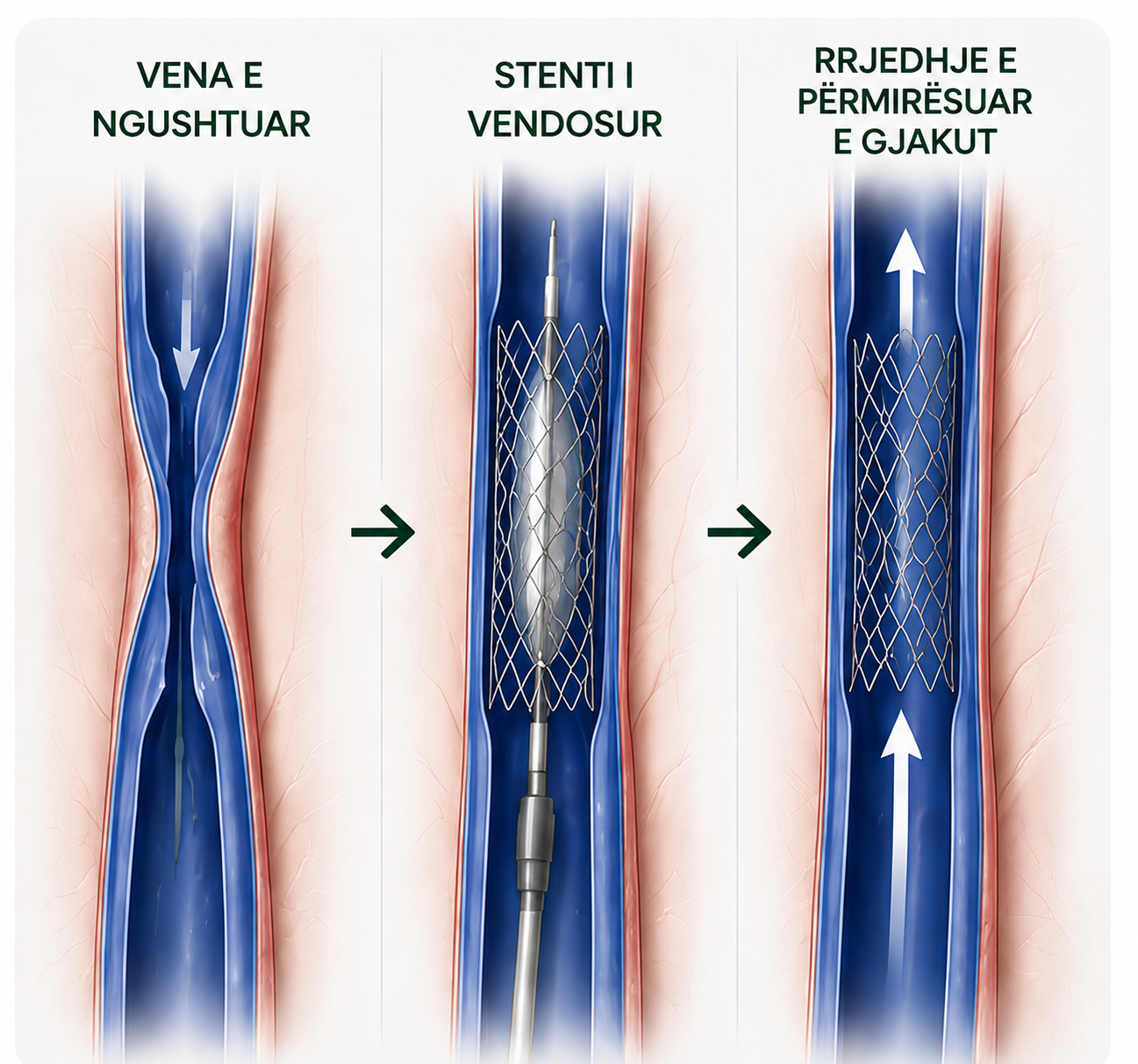 stent venoz