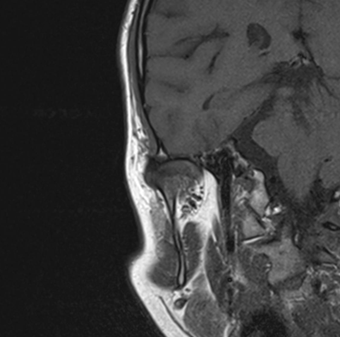 tmj mri