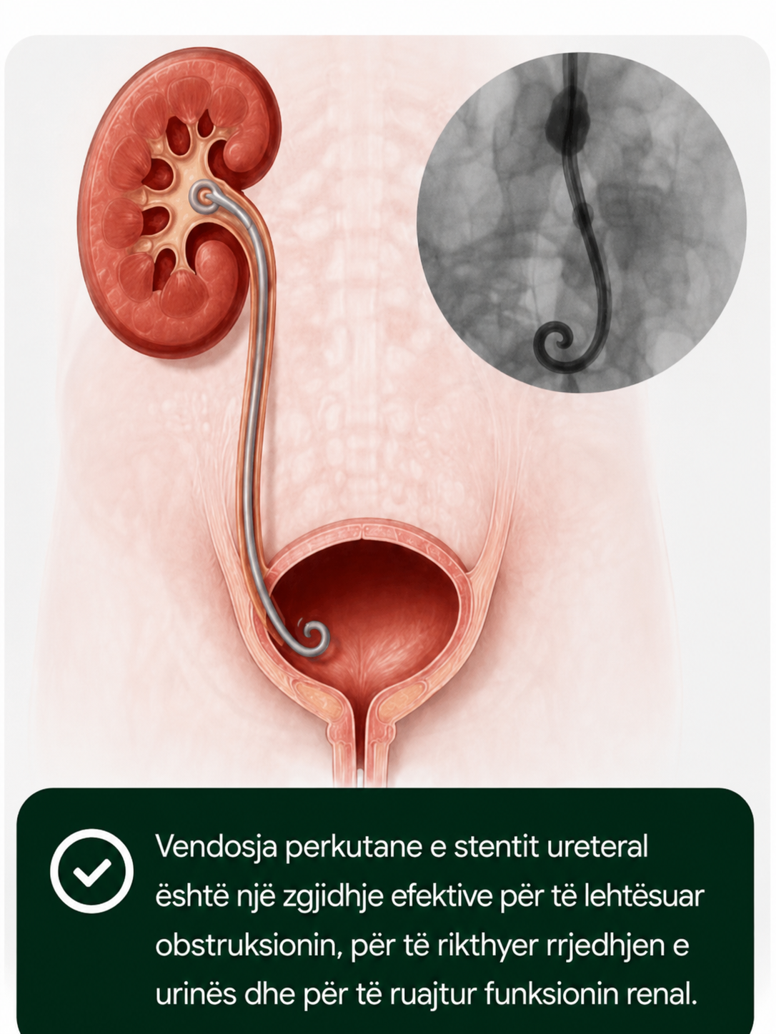 vendosja stentit ureteral