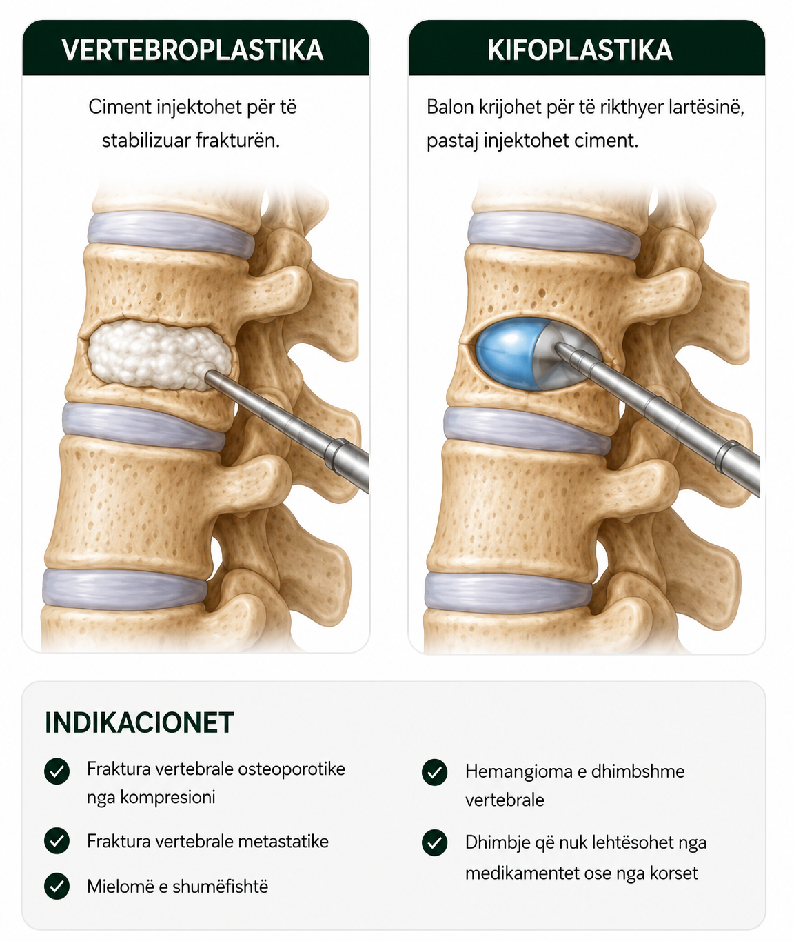 vertebroplastike kifoplastike