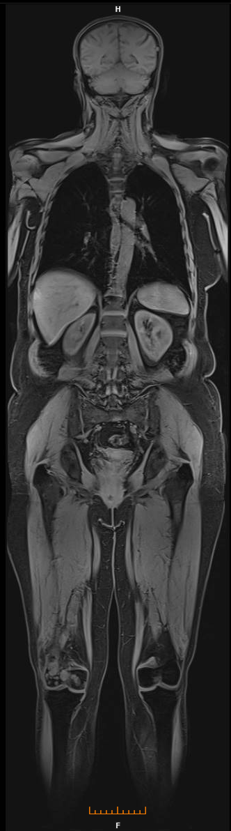 whole body mri