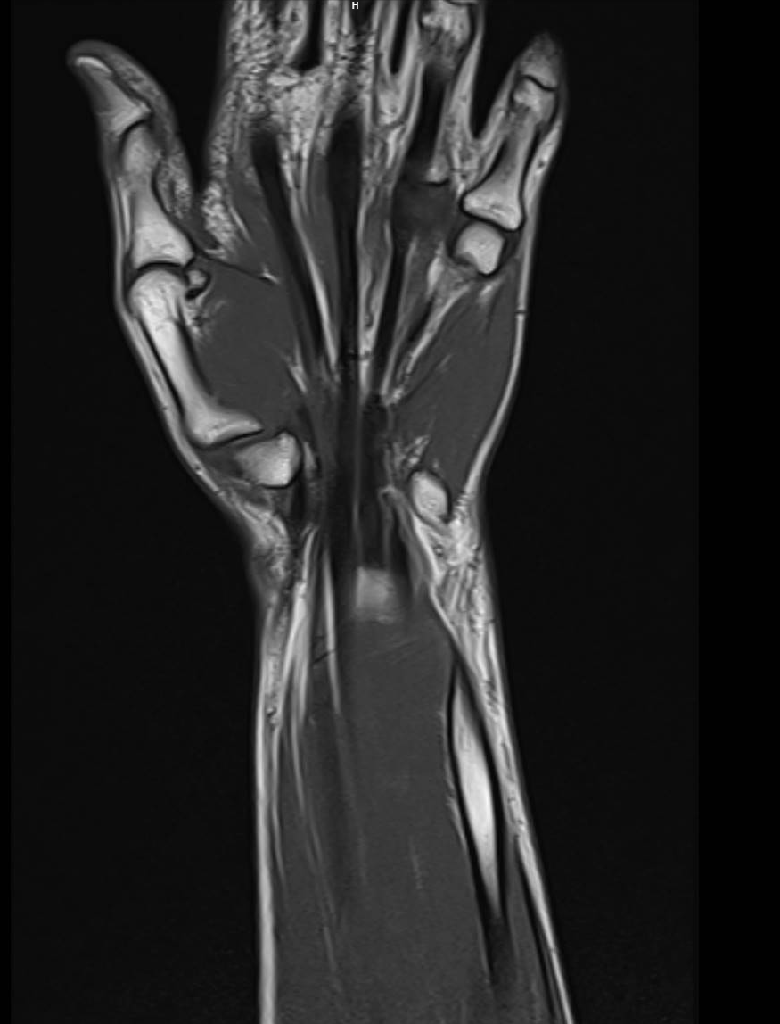 wrist mri