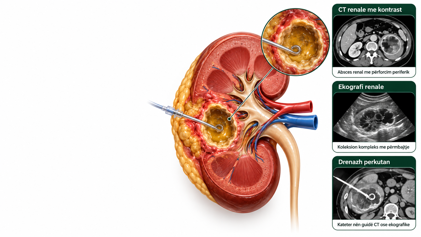 abscesi renal & perirenal