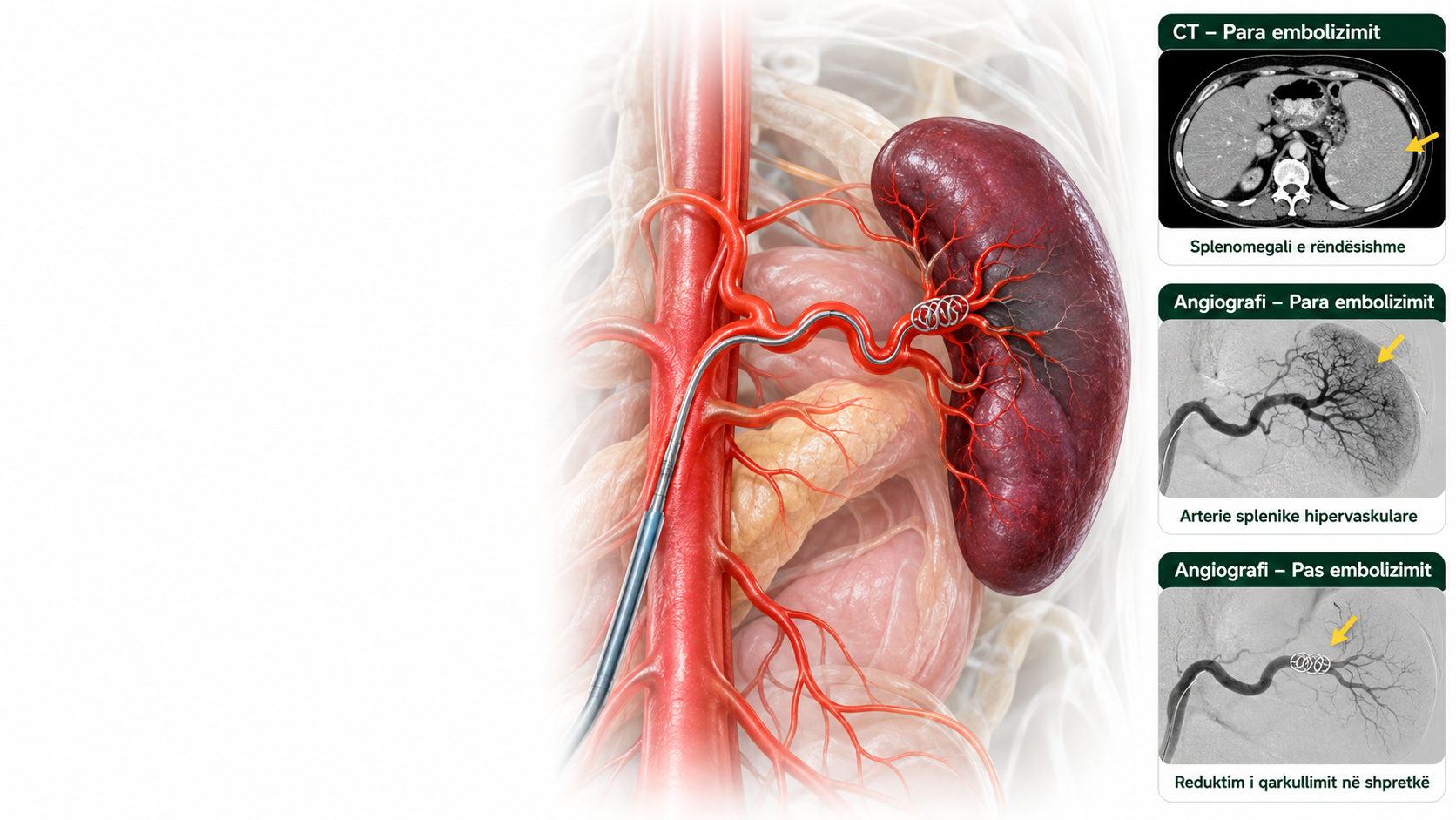 embolizimi i arteries splenike