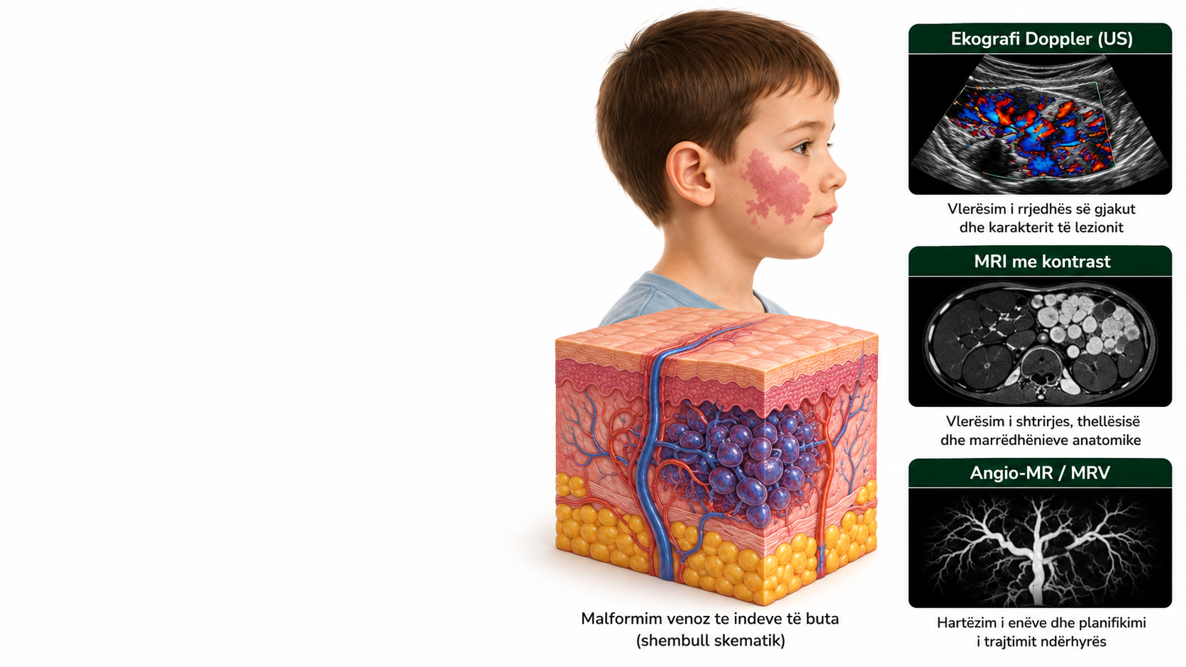 malformacionet vaskulare
