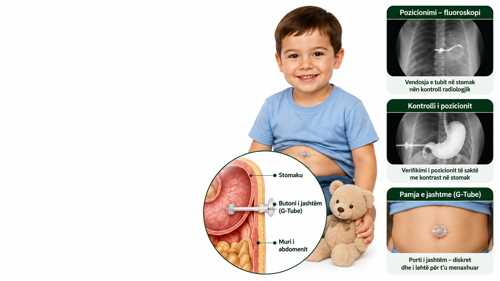 vendosja e tubit të gastrostomisë në pediatri