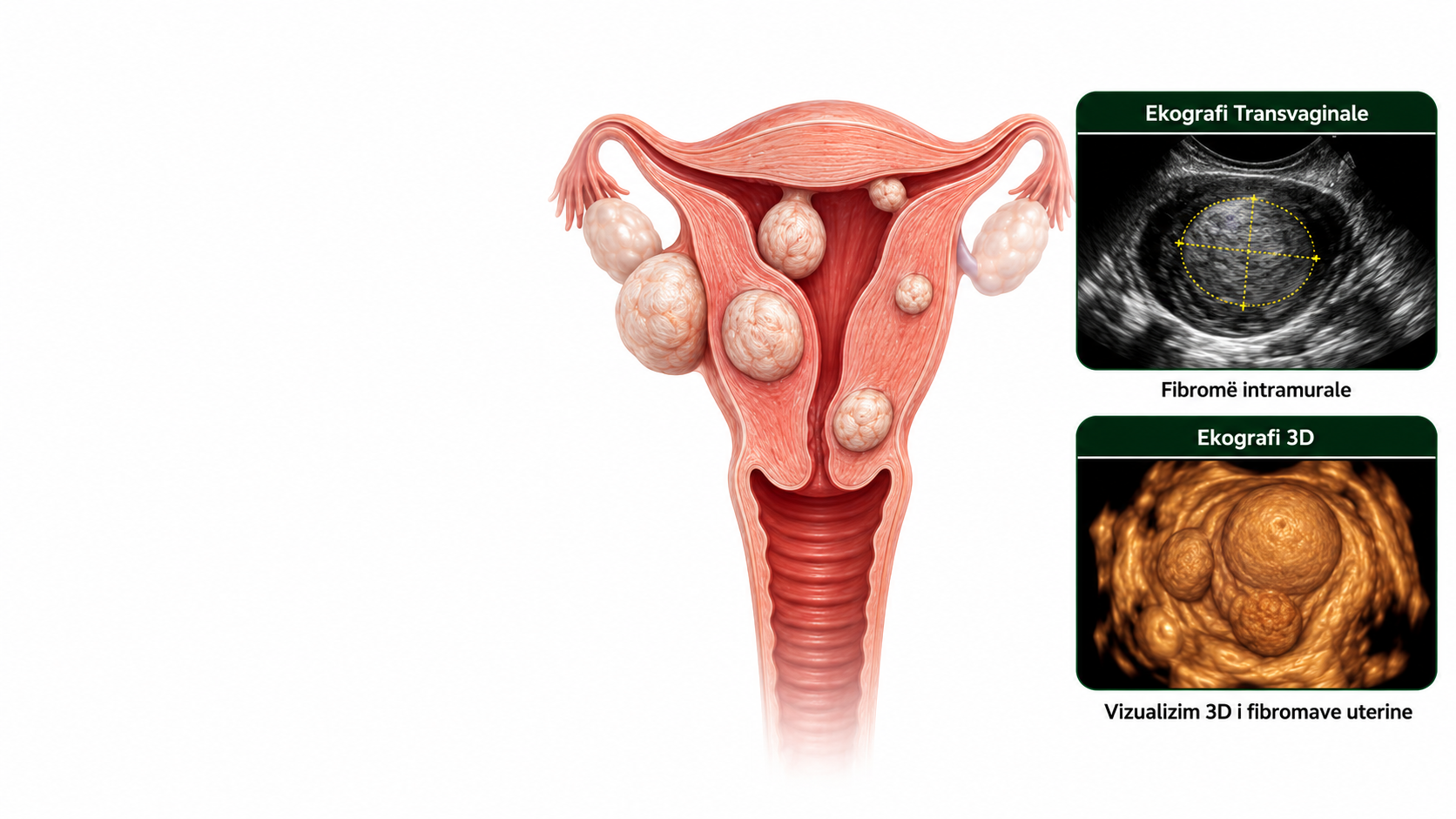 fibromiomat uterine
