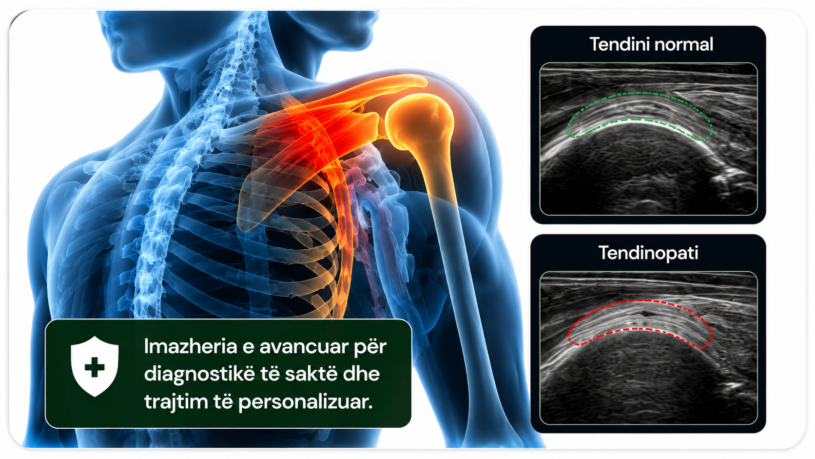 tendinopatia