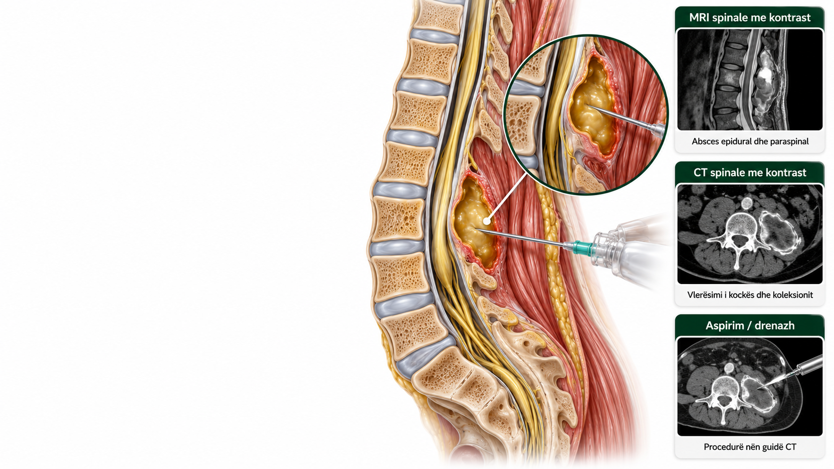 absces spinal & paraspinal