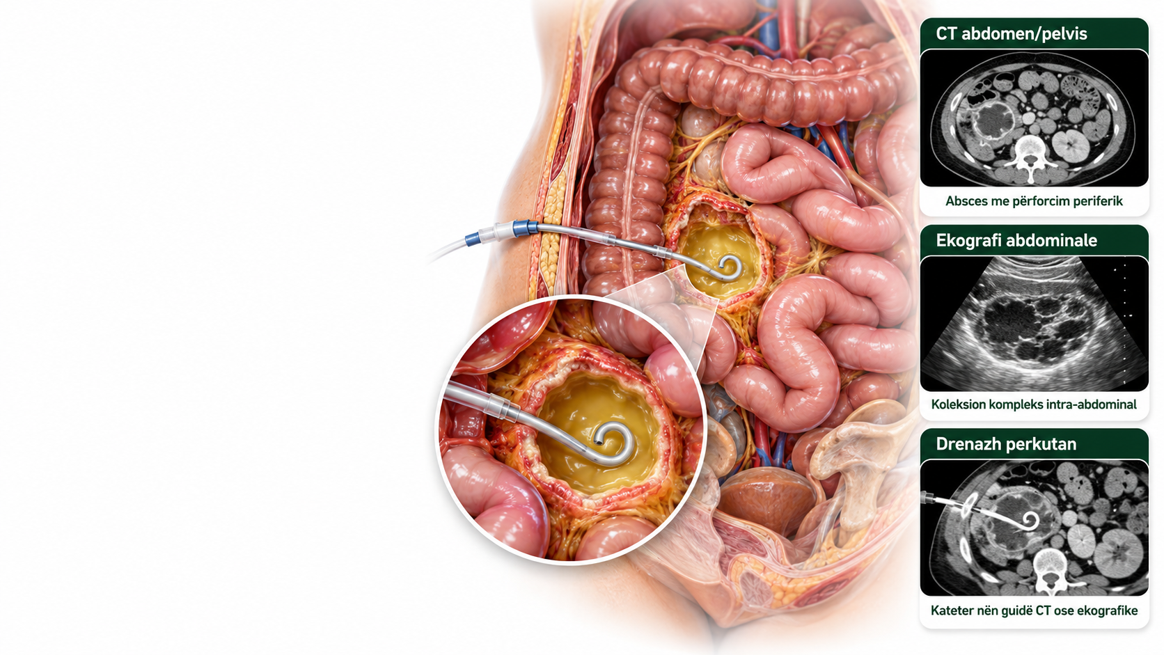 abscesi intra abdominal