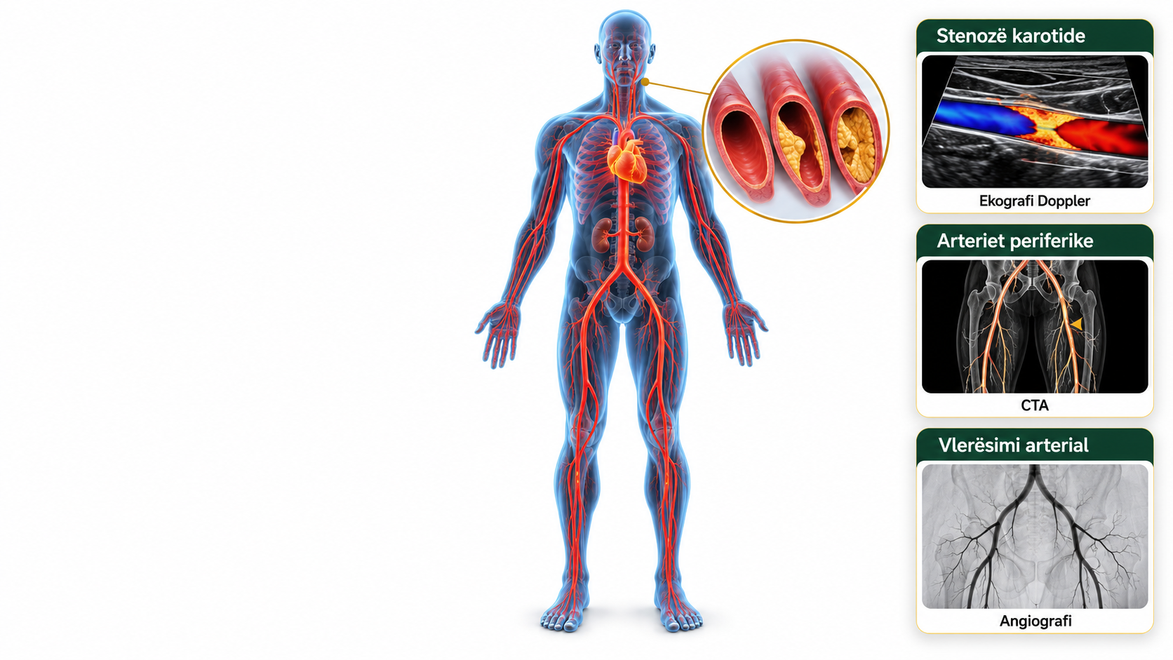 sëmundjet arteriale