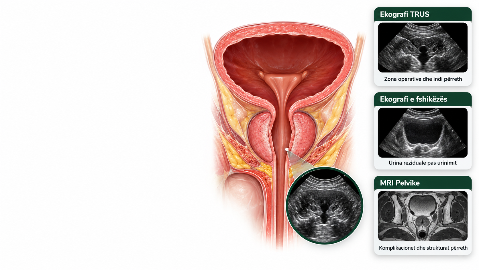 Monitorimi pas Kirurgjisë së Prostatës